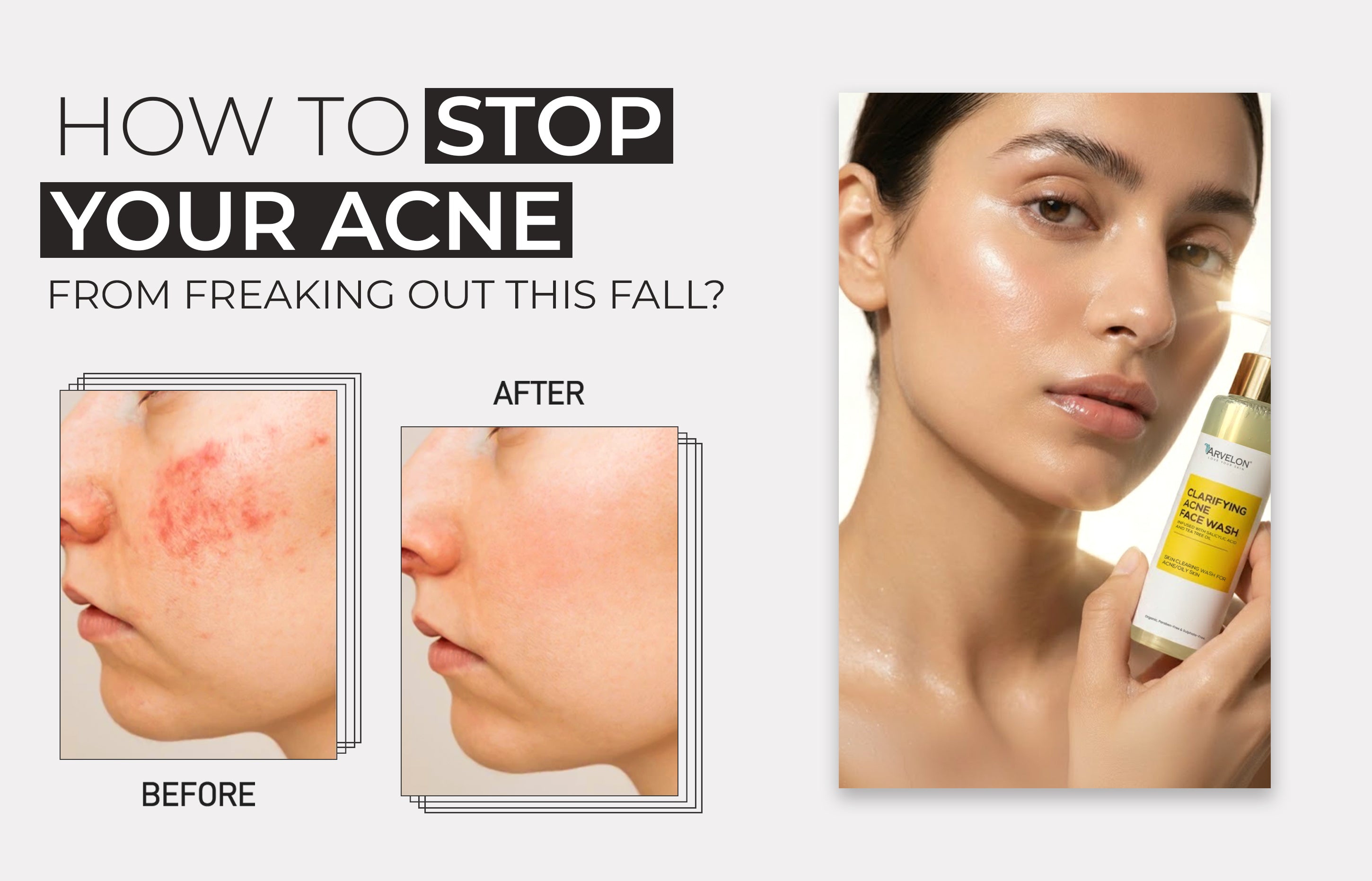How to Stop Your Acne From Freaking Out This Fall